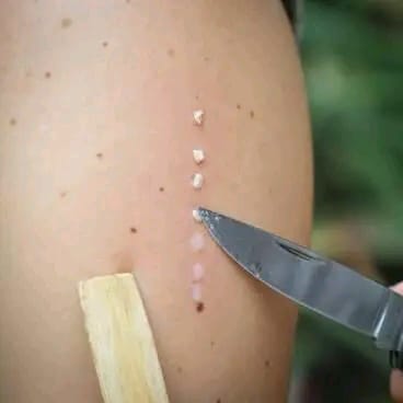 Tiny burns being made on the skin to open the lymphatic points